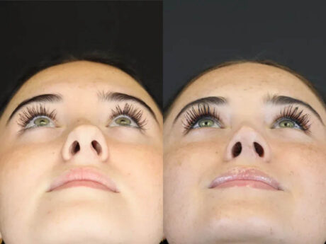 Rhinoplasty case #4321