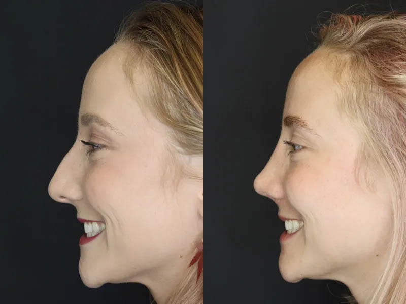 Rhinoplasty case #4334