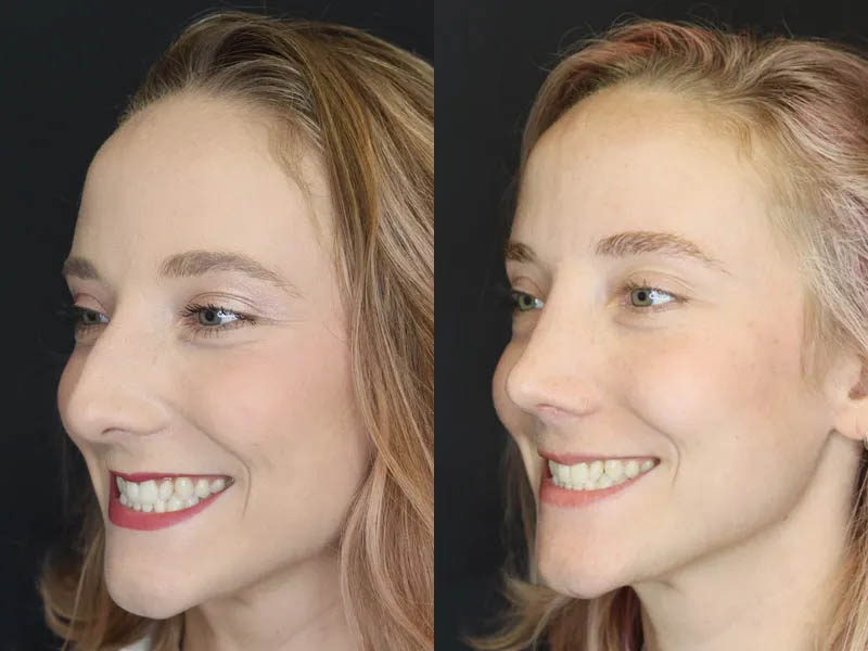 Rhinoplasty case #4334