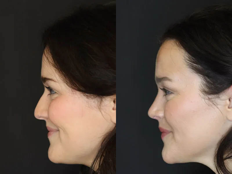 Rhinoplasty case #4354