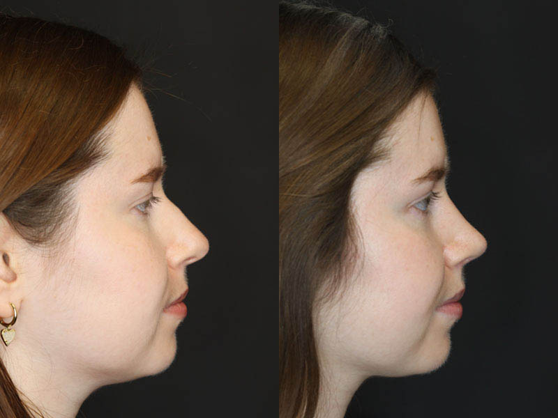 Rhinoplasty case #3946
