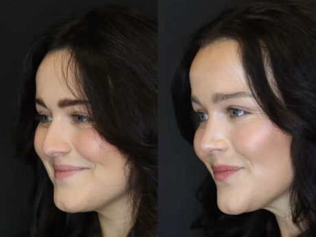 Rhinoplasty case #4354