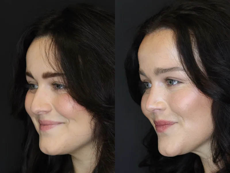 Rhinoplasty case #4354