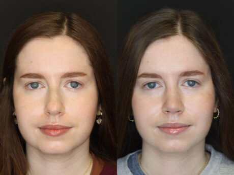 Rhinoplasty case #3946