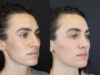 Rhinoplasty case #4383 slider thumbnail