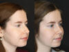 Rhinoplasty case #3946 slider thumbnail