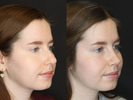 Rhinoplasty case #3946