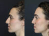 Rhinoplasty case #4383 slider thumbnail