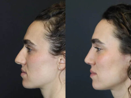 Rhinoplasty case #4383
