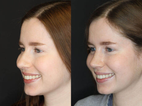 Rhinoplasty case #3946