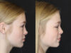 Rhinoplasty case #3947 slider thumbnail