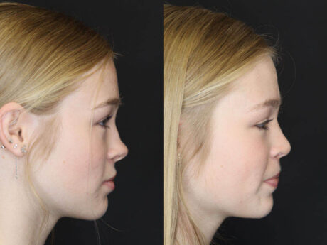 Rhinoplasty case #3947