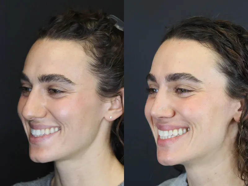 Rhinoplasty case #4383