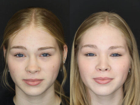 Rhinoplasty case #3947