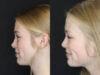 Rhinoplasty case #3947 slider thumbnail
