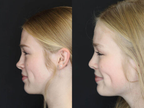 Rhinoplasty case #3947