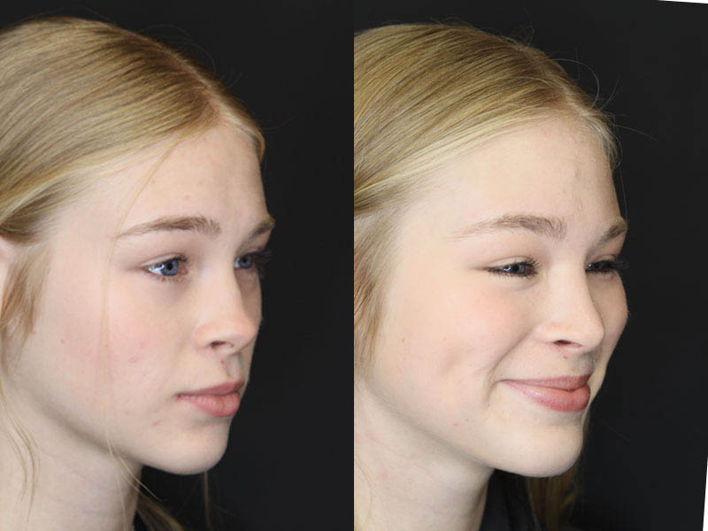 Rhinoplasty case #3947