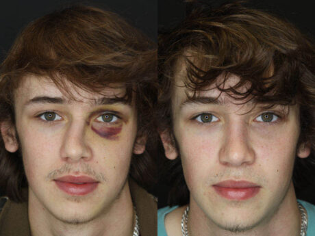 Rhinoplasty case #3958