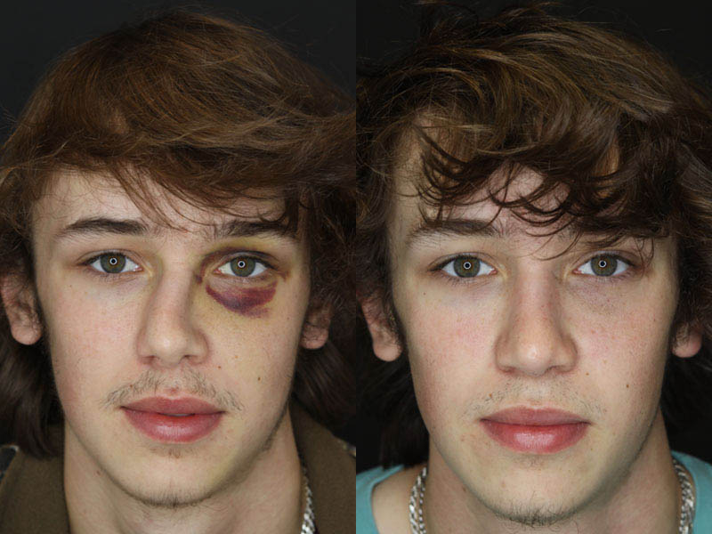 Rhinoplasty case #3958
