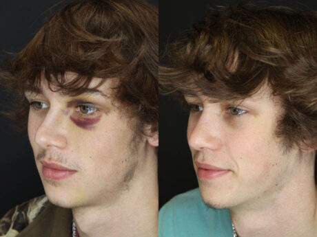 Rhinoplasty case #3958