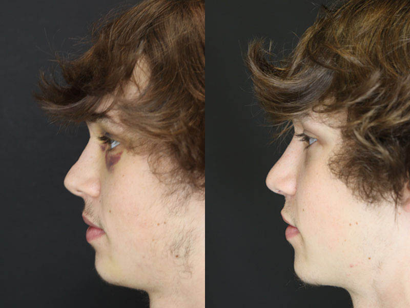 Rhinoplasty case #3958