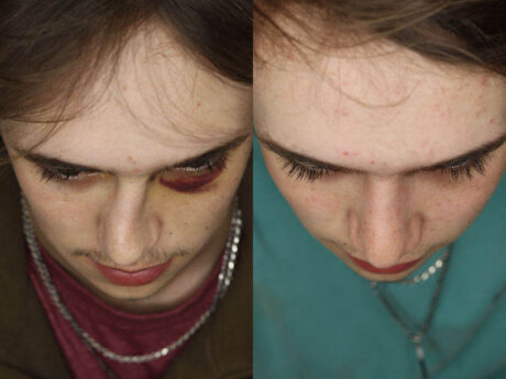 Rhinoplasty case #3958