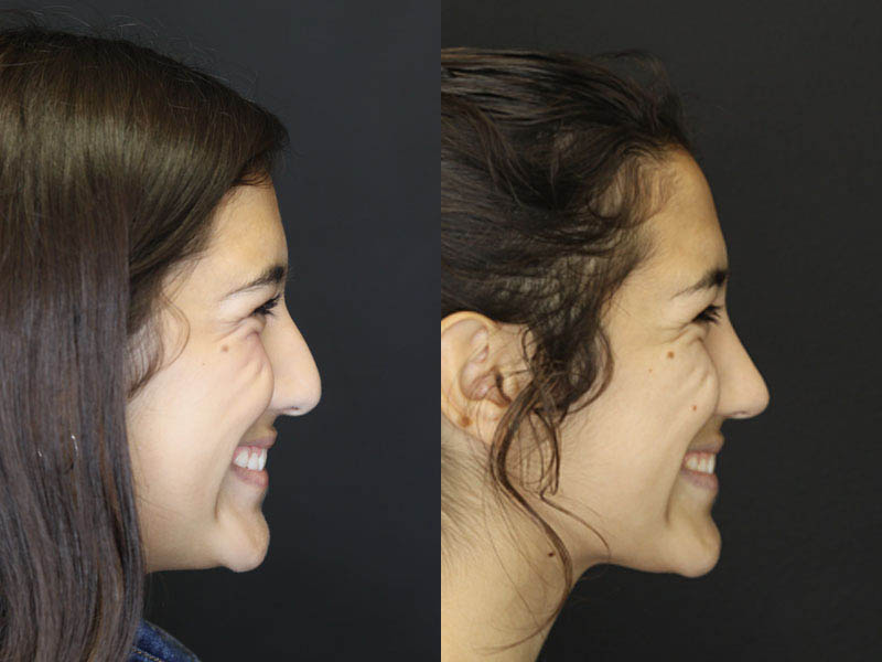 Rhinoplasty case #3967