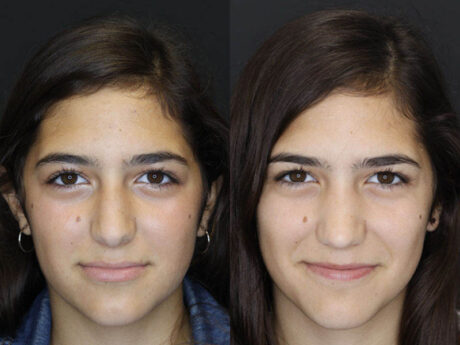 Rhinoplasty case #3967