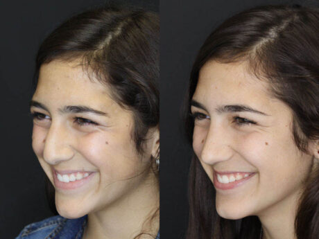 Rhinoplasty case #3967