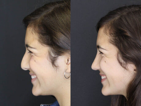 Rhinoplasty case #3967