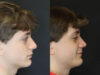 Rhinoplasty case #3982 slider thumbnail