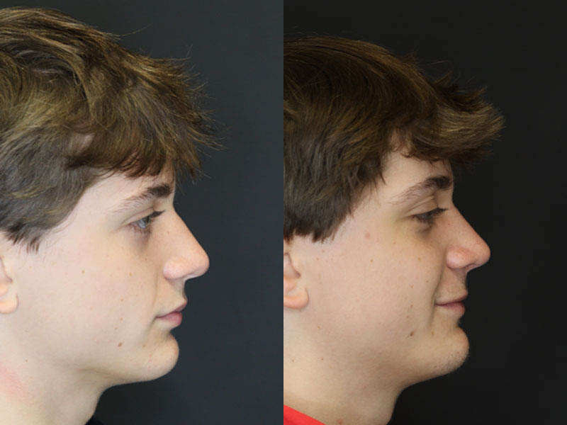 Rhinoplasty case #3982