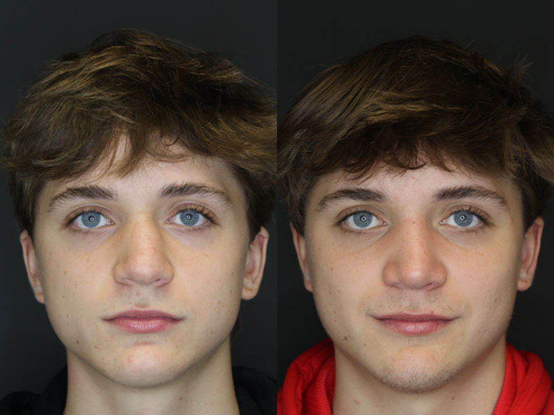 Rhinoplasty case #3982
