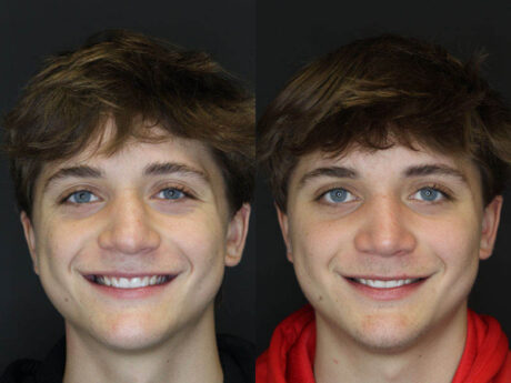 Rhinoplasty case #3982