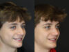 Rhinoplasty case #3982 slider thumbnail