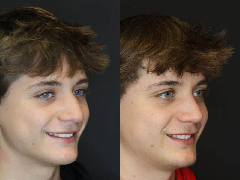 Rhinoplasty case #3982