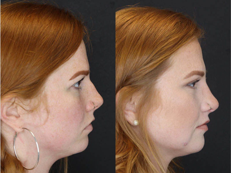 Rhinoplasty case #3997