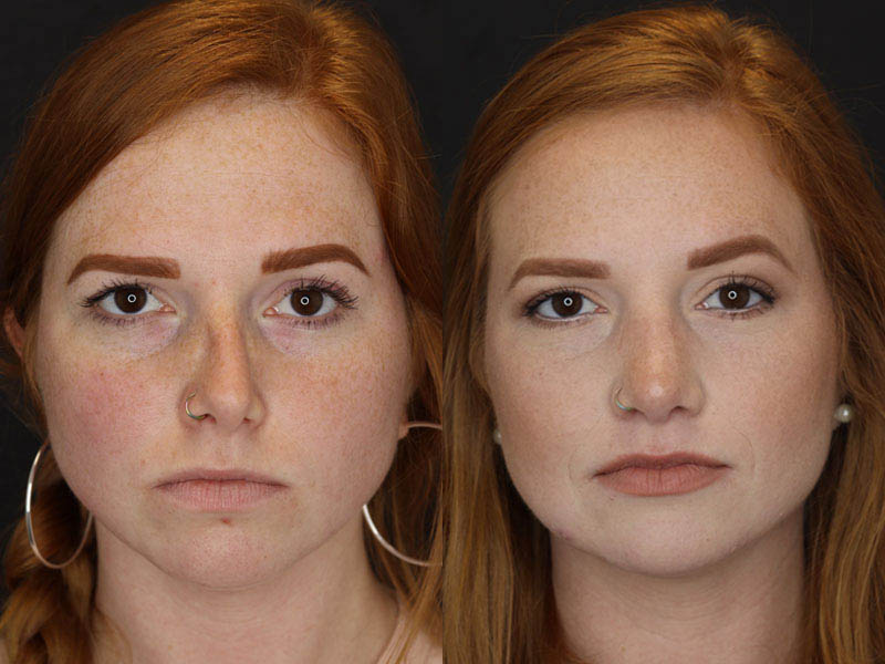 Rhinoplasty case #3997
