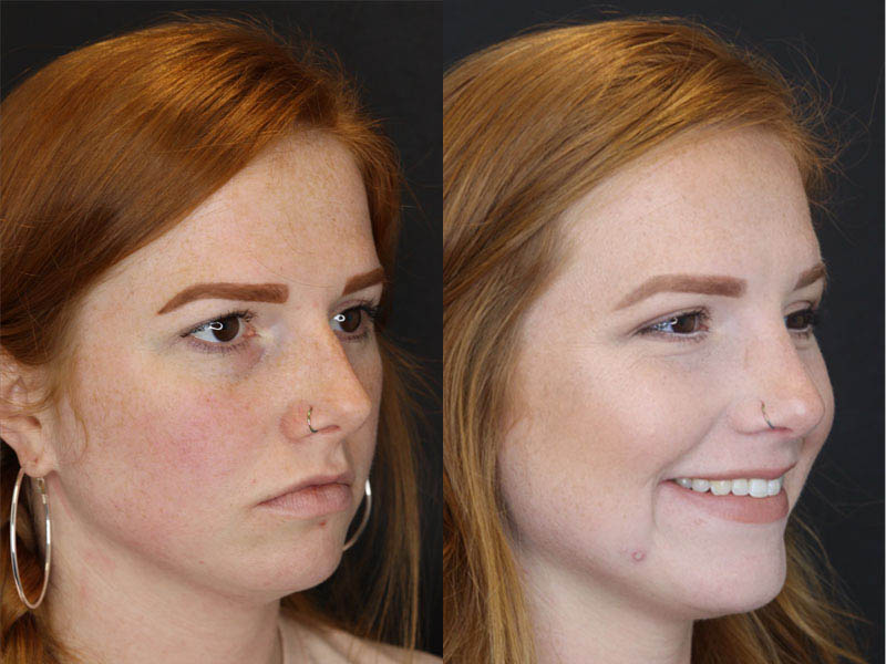 Rhinoplasty case #3997