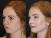 Rhinoplasty case #3997 slider thumbnail