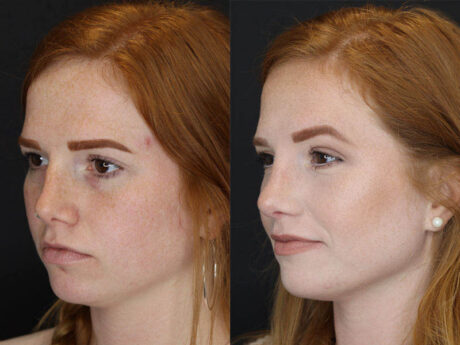 Rhinoplasty case #3997
