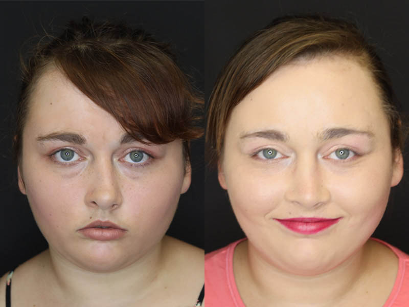 Rhinoplasty case #4086