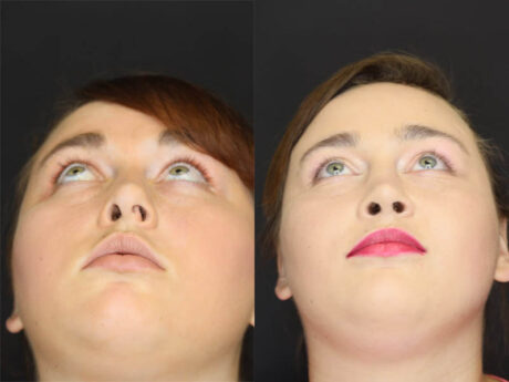 Rhinoplasty case #4086