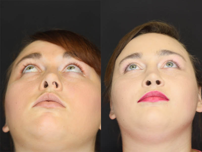 Rhinoplasty case #4086