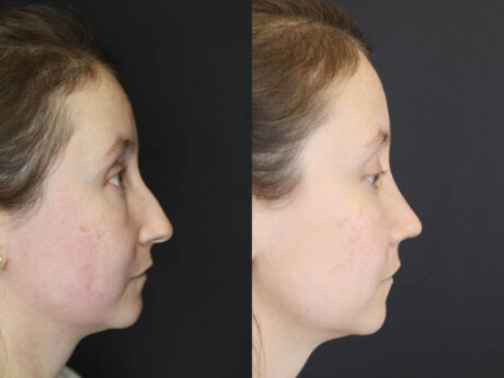 Rhinoplasty case #4104