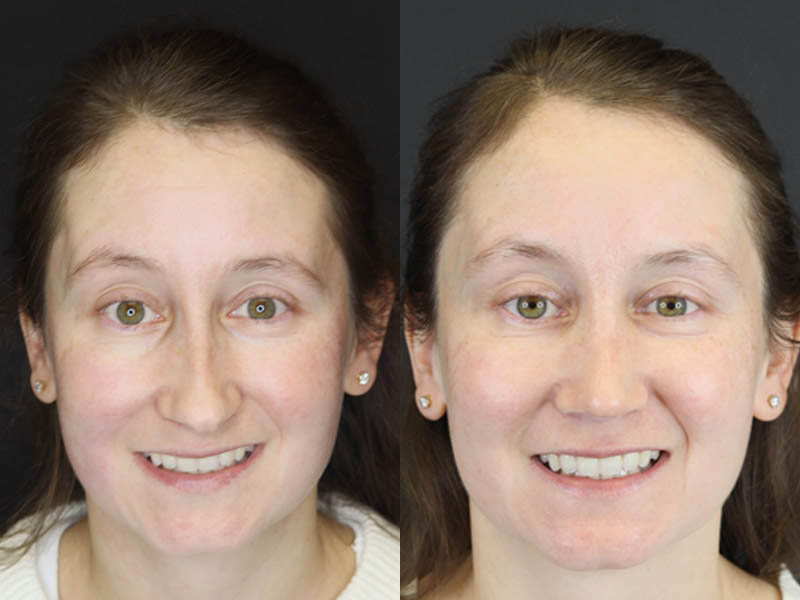 Rhinoplasty case #4104