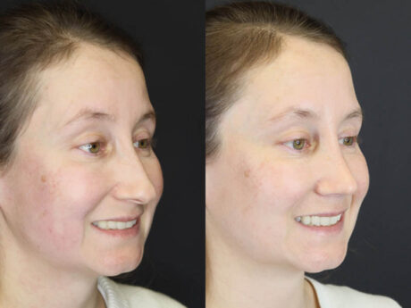 Rhinoplasty case #4104