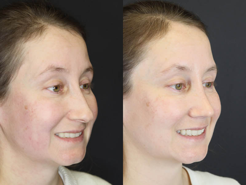 Rhinoplasty case #4104