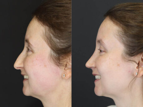 Rhinoplasty case #4104