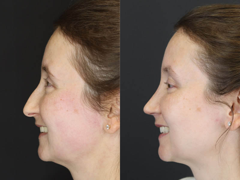 Rhinoplasty case #4104